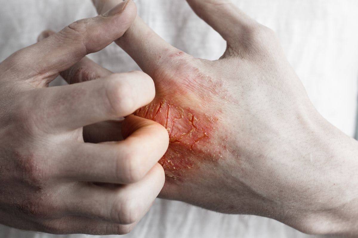 The type 2 inflammatory response causes reactions in the body that lead to skin itchiness, redness, and more.