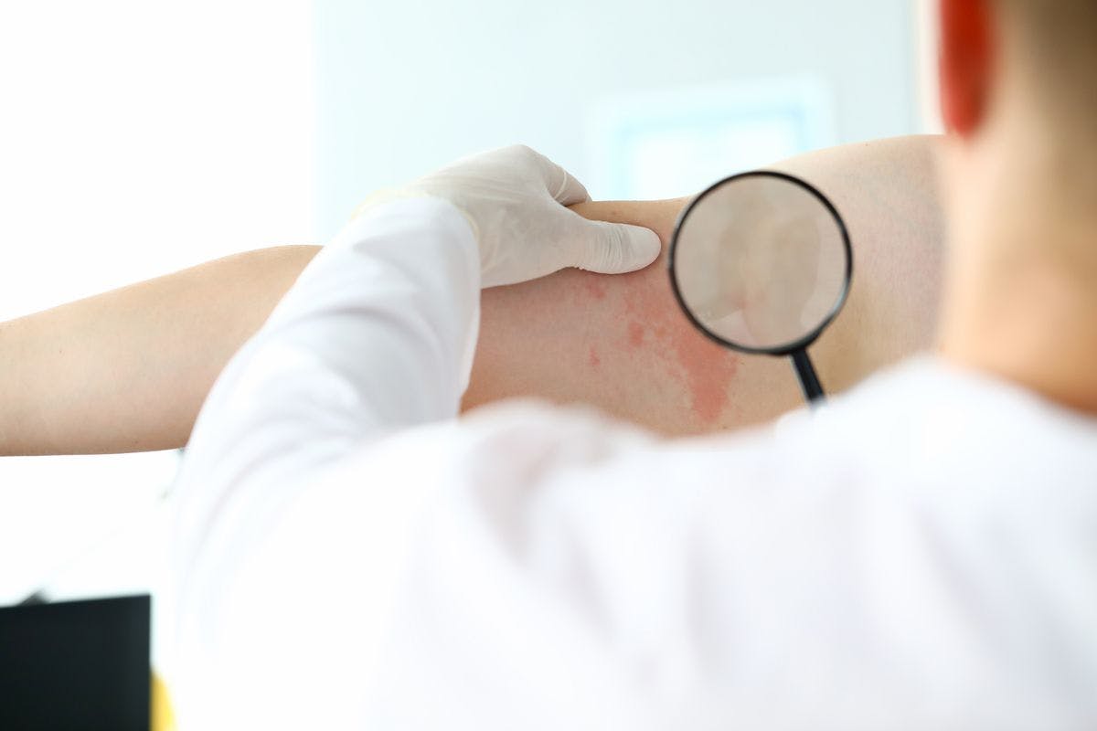 Dupixent Safe, Effective Up to Four Years in Adults With Moderate-to-Severe Atopic Dermatitis