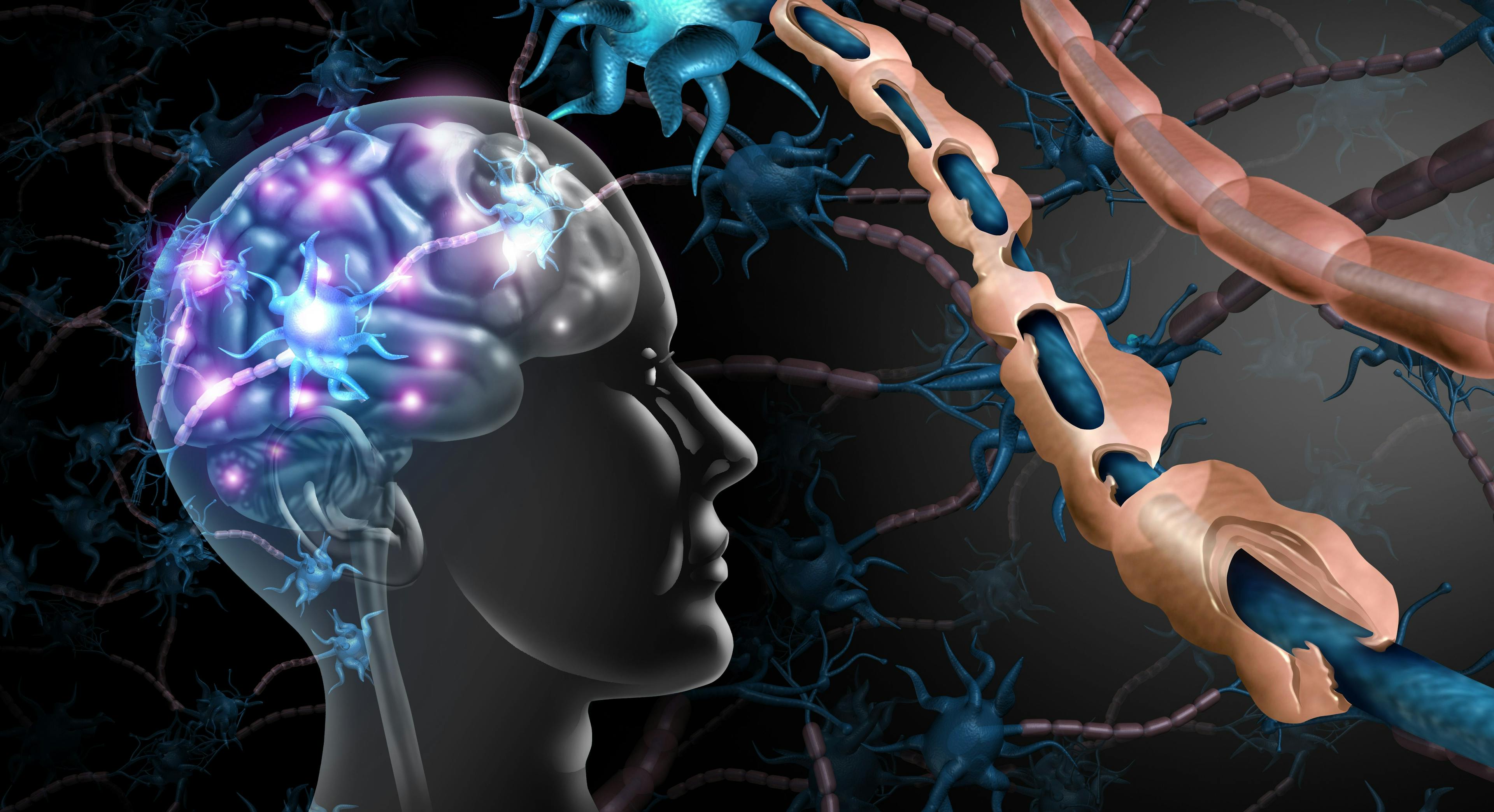 Ozanimod Shows Sustained Efficacy in Long-term Study for Multiple Sclerosis Treatment