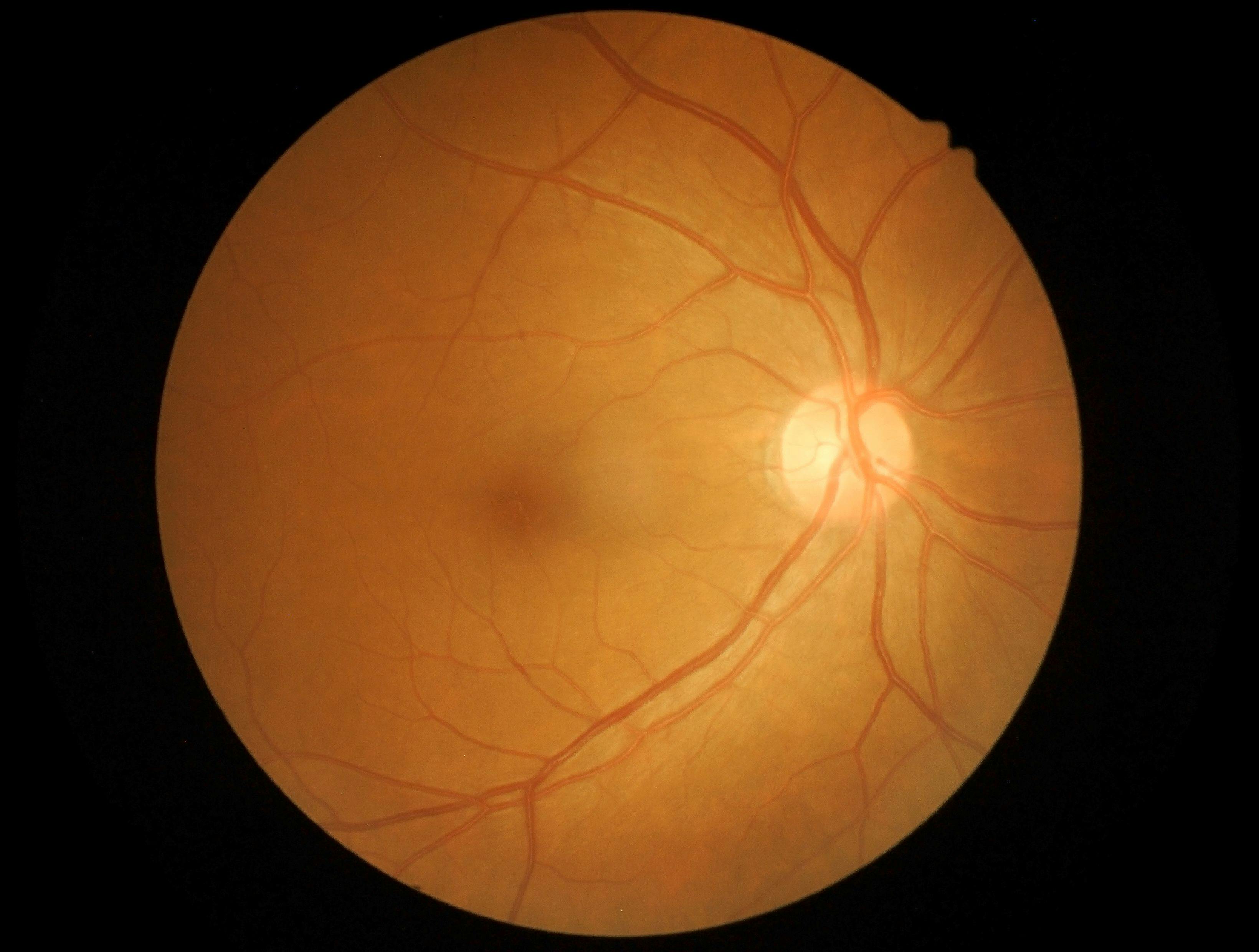 Measuring the Optic Nerve Improves Diagnosis of Multiple Sclerosis