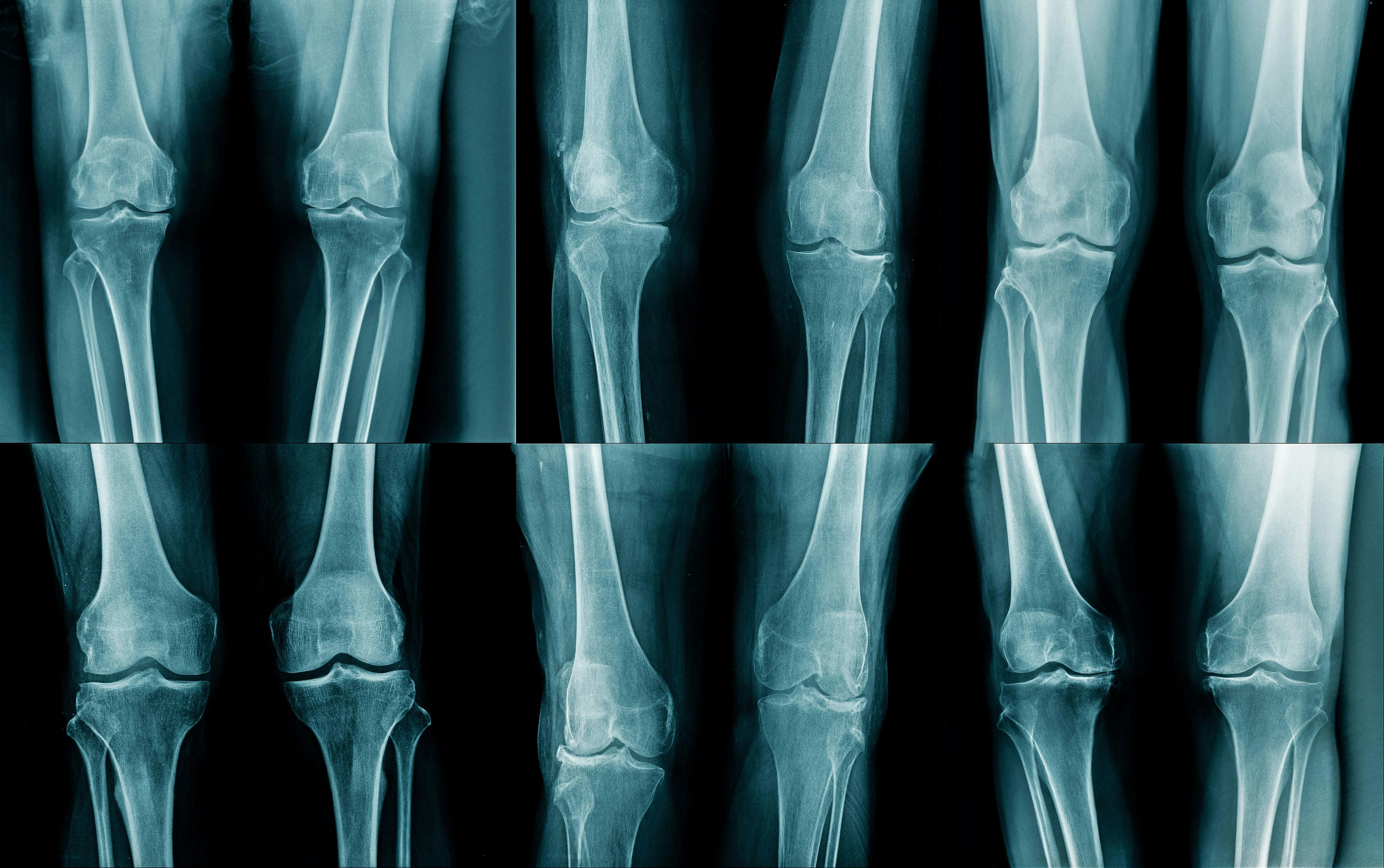 AI May Be Able to Help Diagnose Osteoarthritis Early