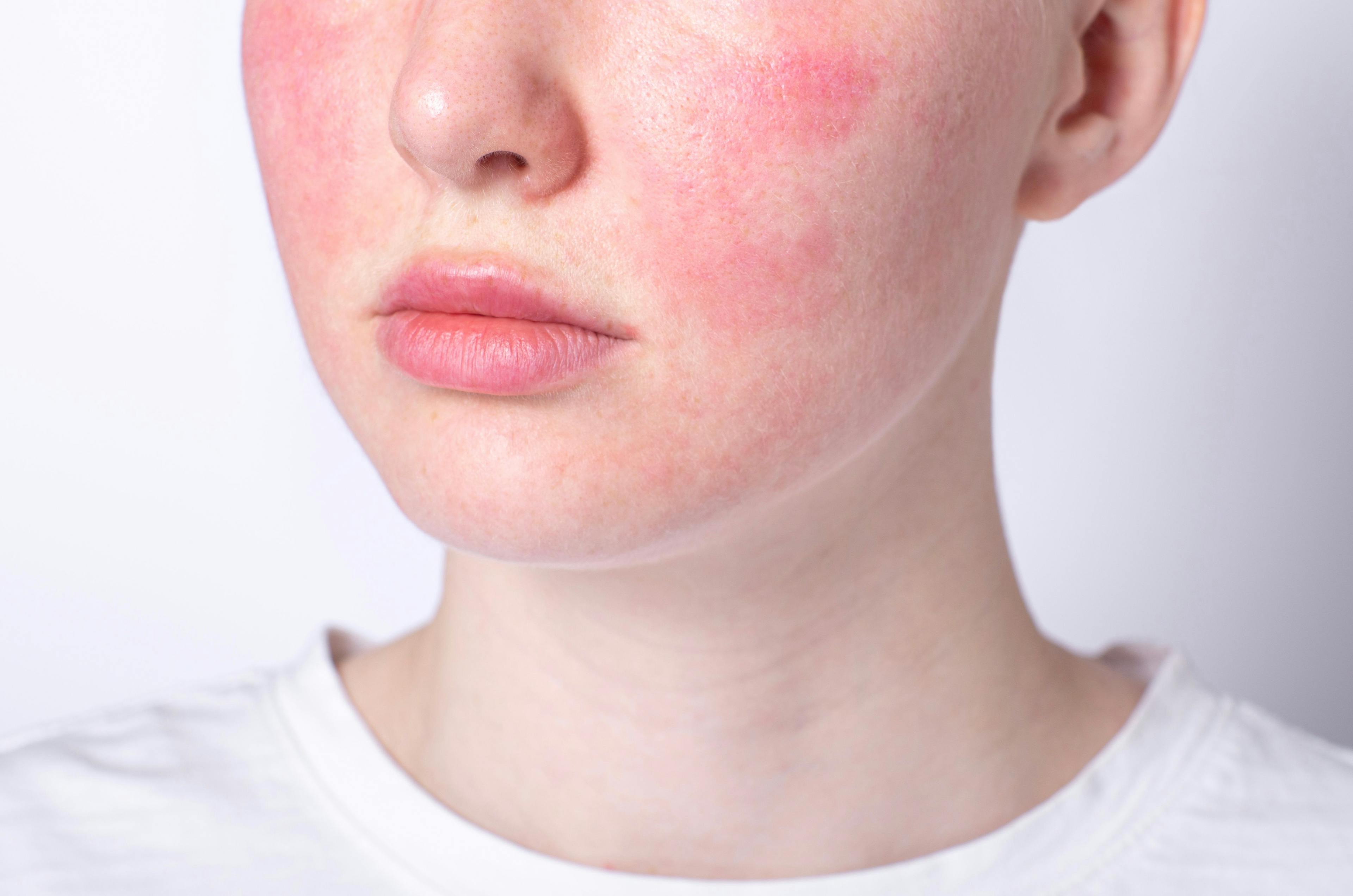 Increased Risk of Rosacea Found in Former Smokers, But Connection is Hazy in Current Smokers