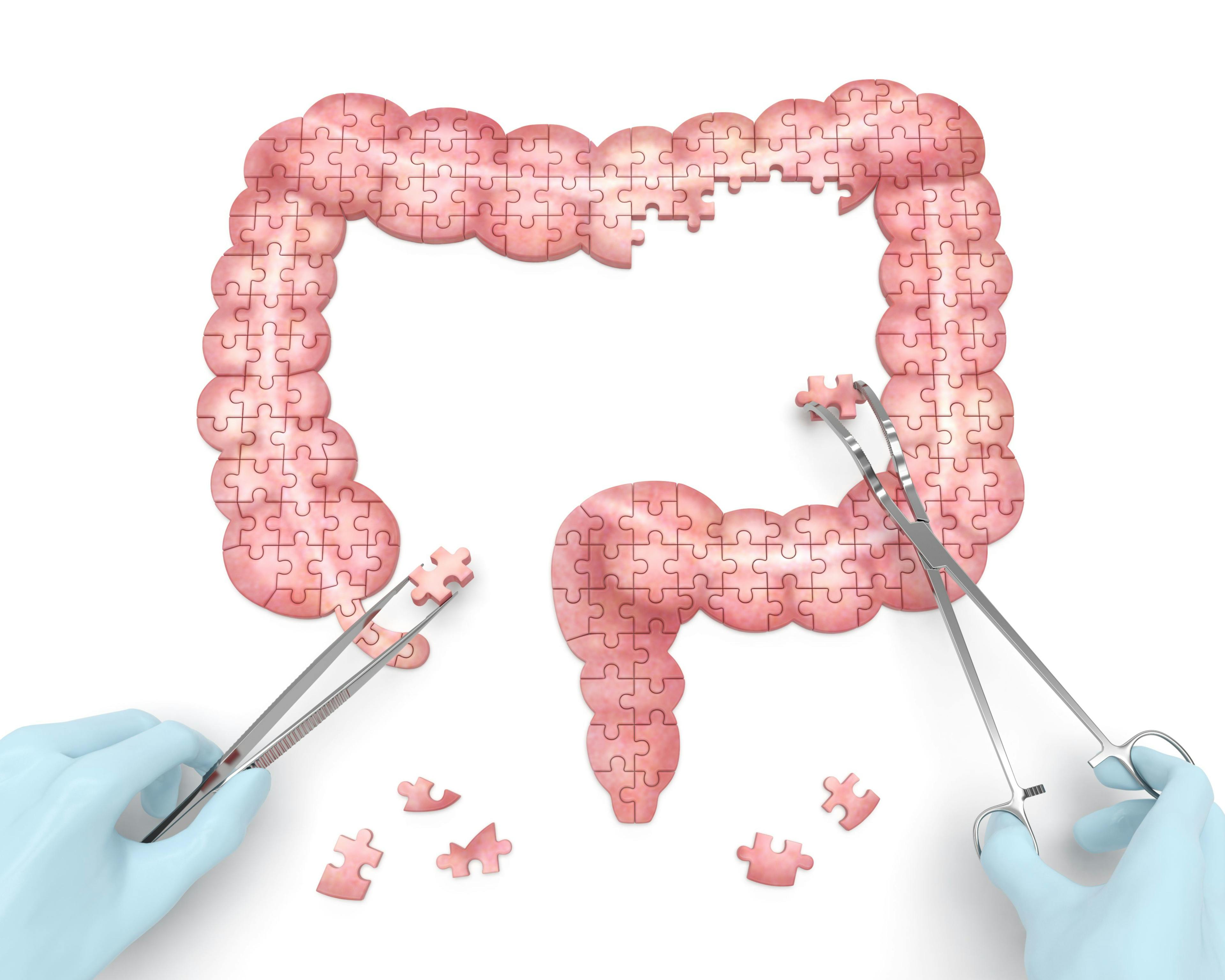 Adverse Events Similar Between JAK Inhibitor Xeljanz and Biologics After Colectomy in UC Patients, Study Finds