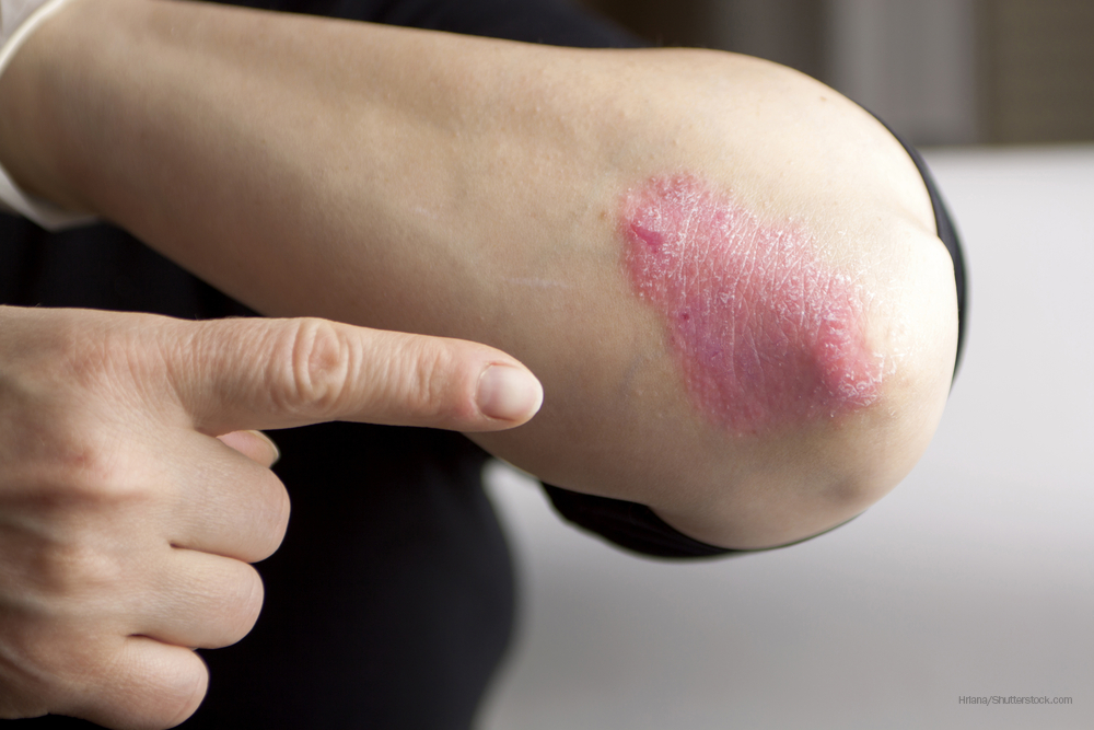 Study Challenges Link Between Psoriasis and Vitiligo