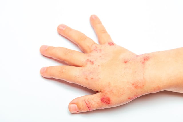 9 Takeaways About Biologic Therapy for Pediatric Psoriasis