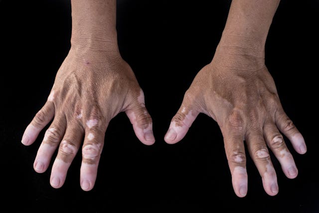 Vitiligo Patients Face Lower Parkinson’s Disease Risk, but Higher Mortality and Health Issues if Both Conditions Co-Exist
