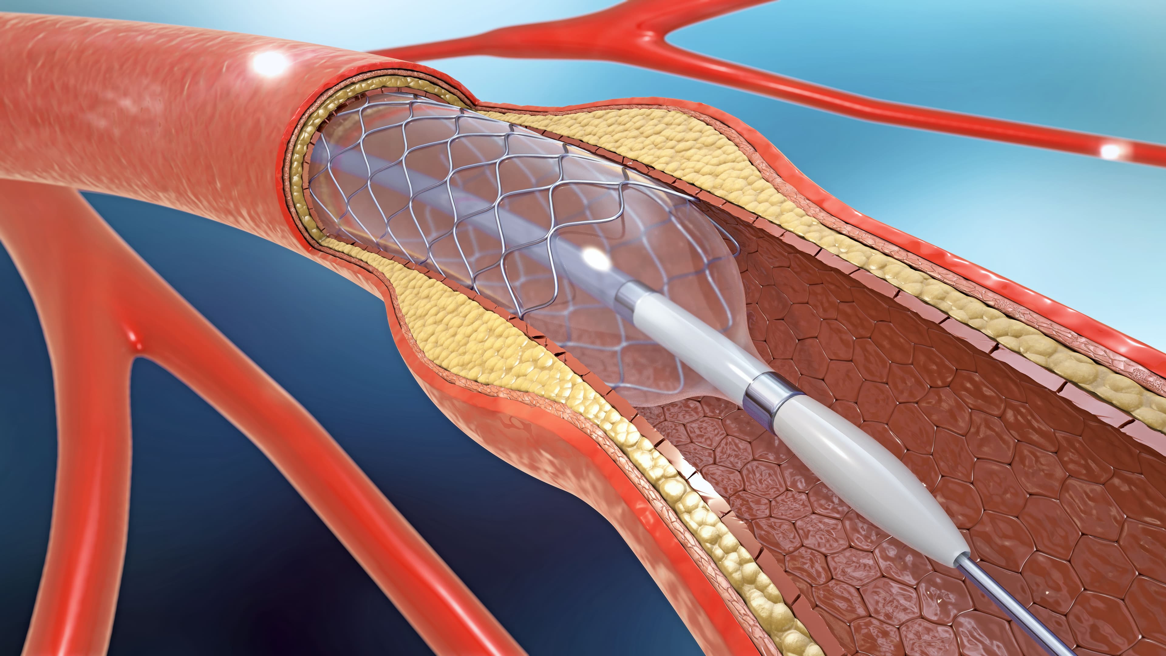 Hospitals, Physicians Investigated for Unnecessary Angioplasties