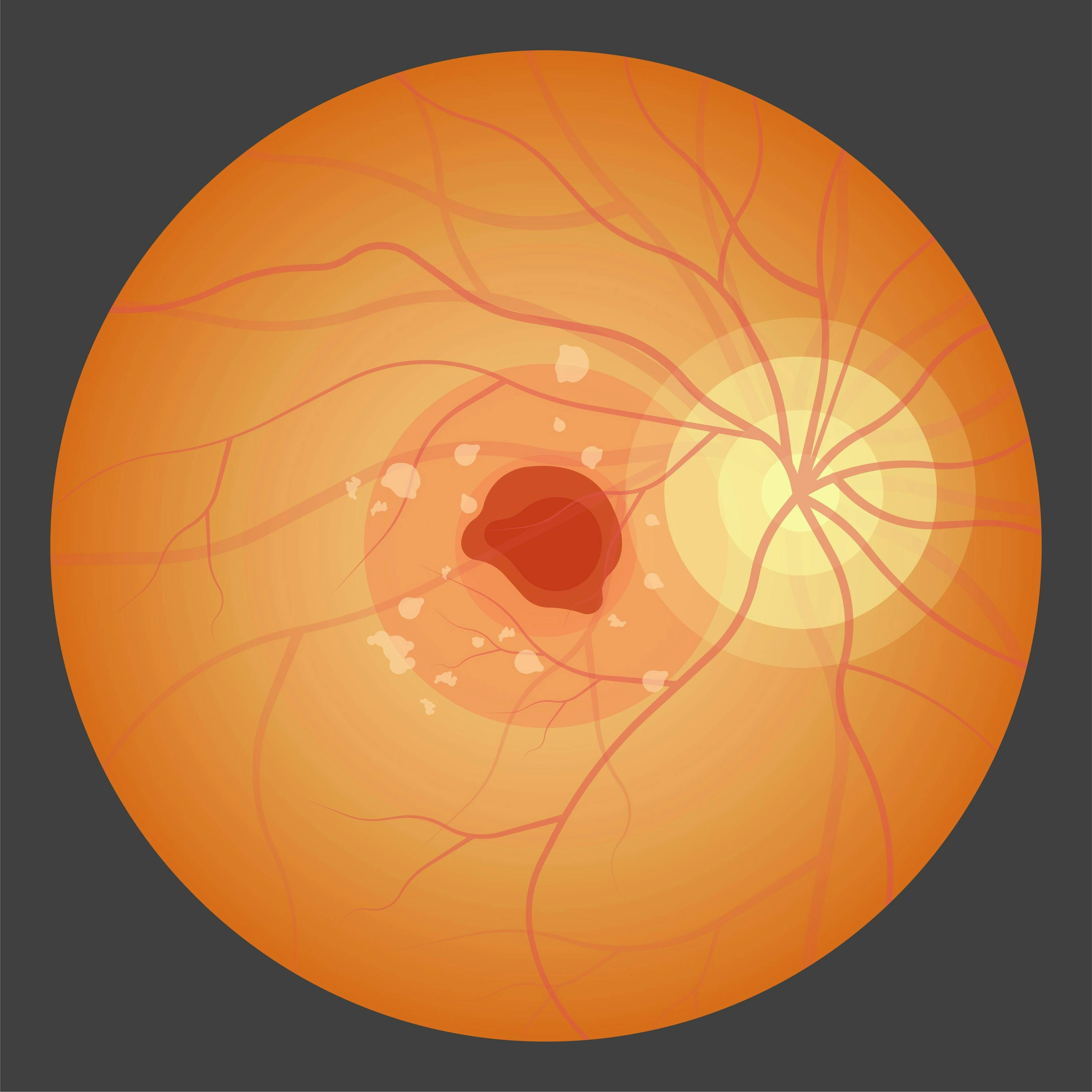 neovascular age-related macular degeneration © pepermpron - stock.adobe.com