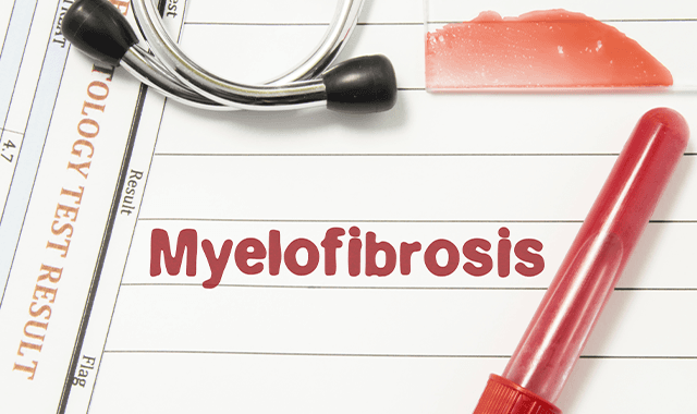 Survival Rates for Myelofibrosis Have Increased Over the Last Two Decades