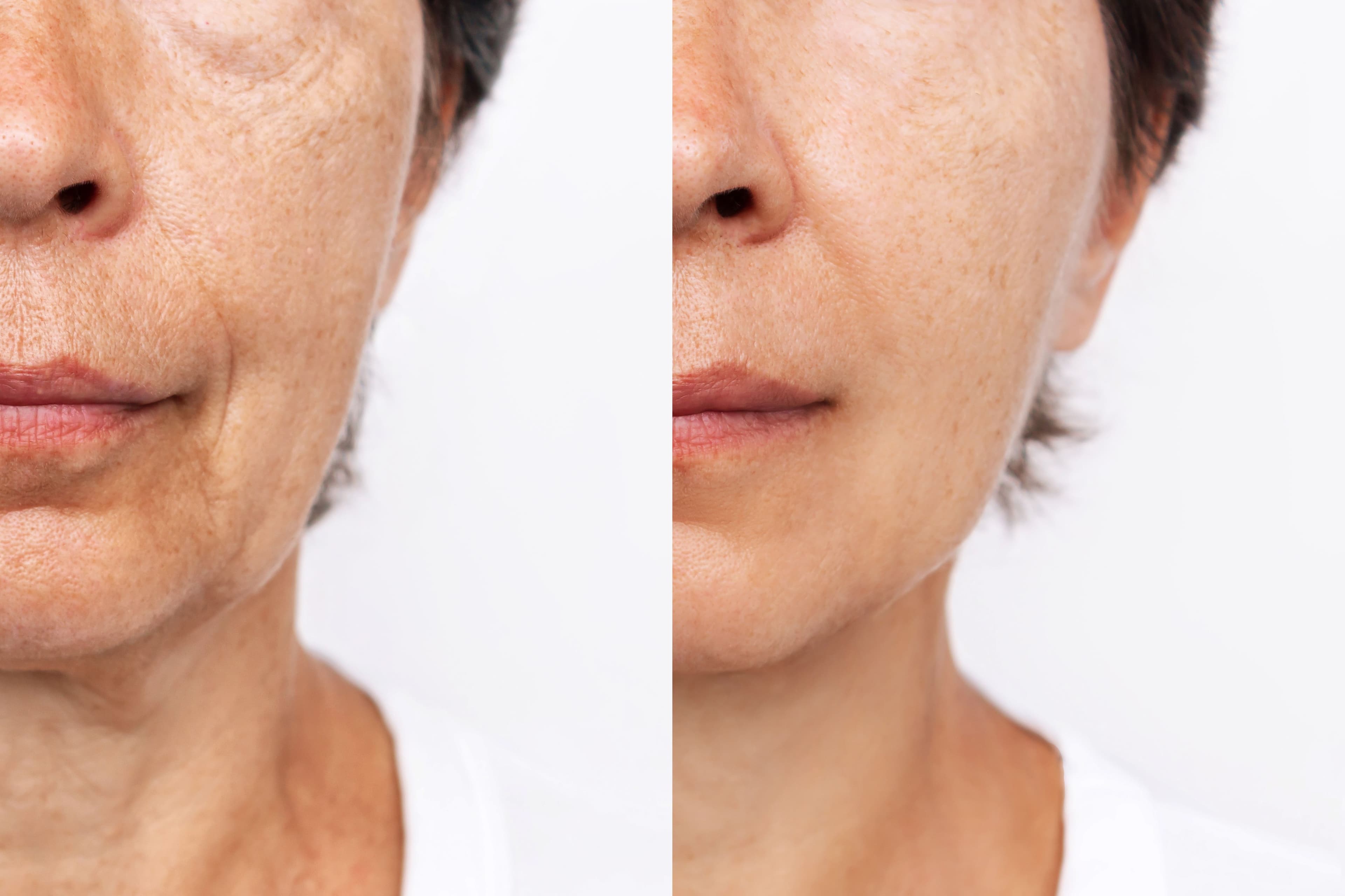 The Ozempic Bod Gets Trimmer, ‘Ozempic Face’ Gets Older  | AAO 2024