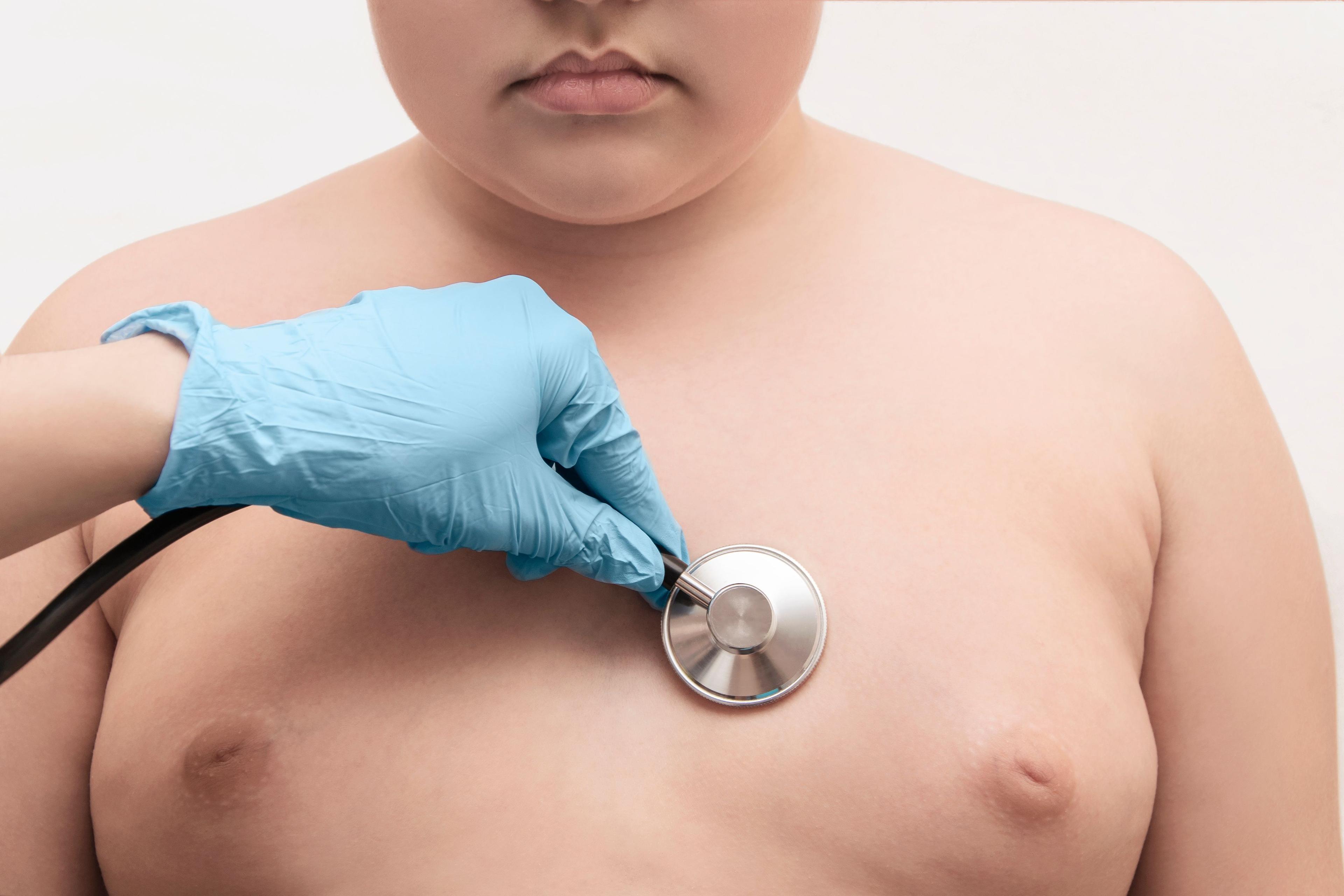 Study Links Childhood Obesity to Increased Risk of Atopic Dermatitis