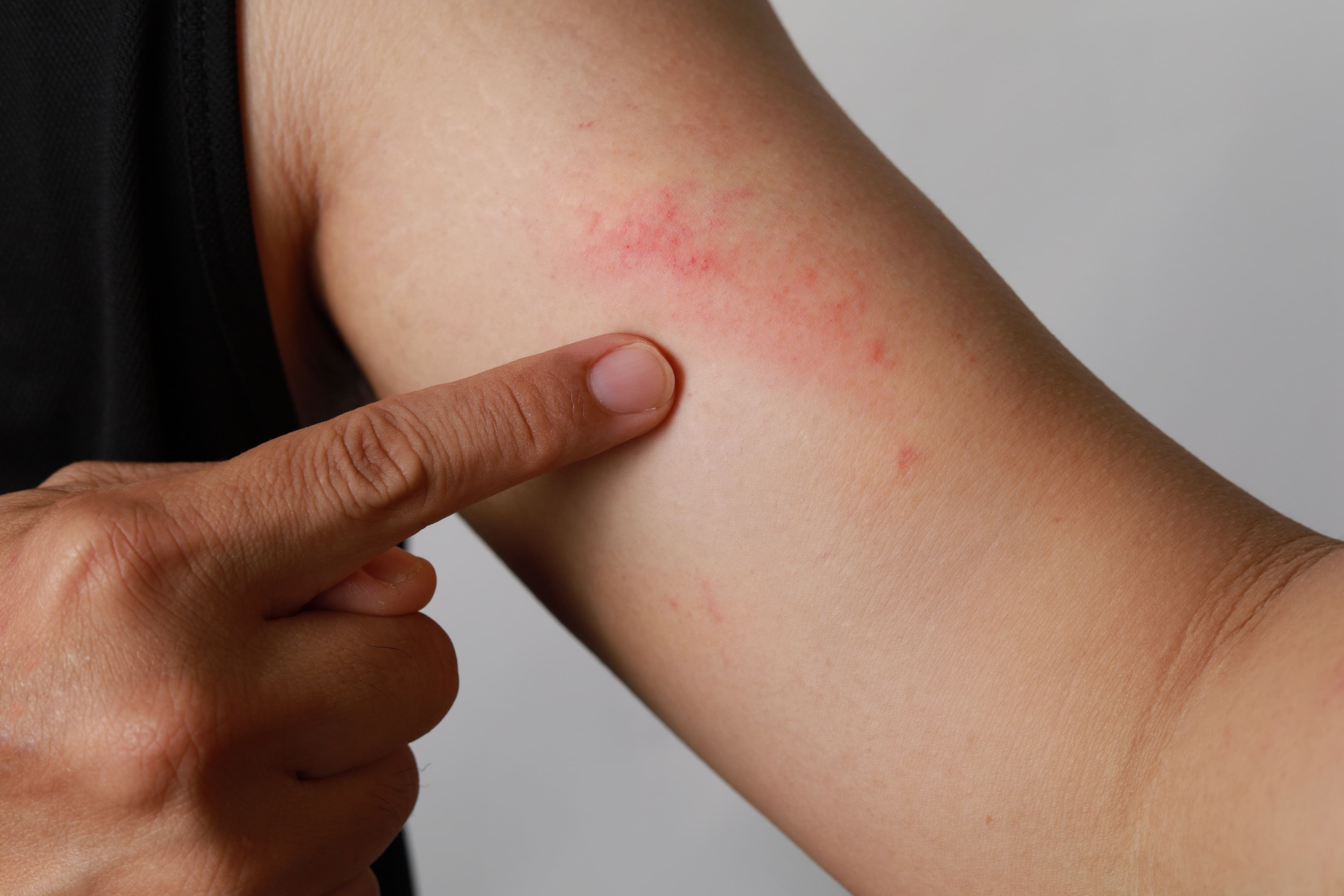 Long-Term Dupixent Treatment Shows Promising Results for Severe Atopic Dermatitis