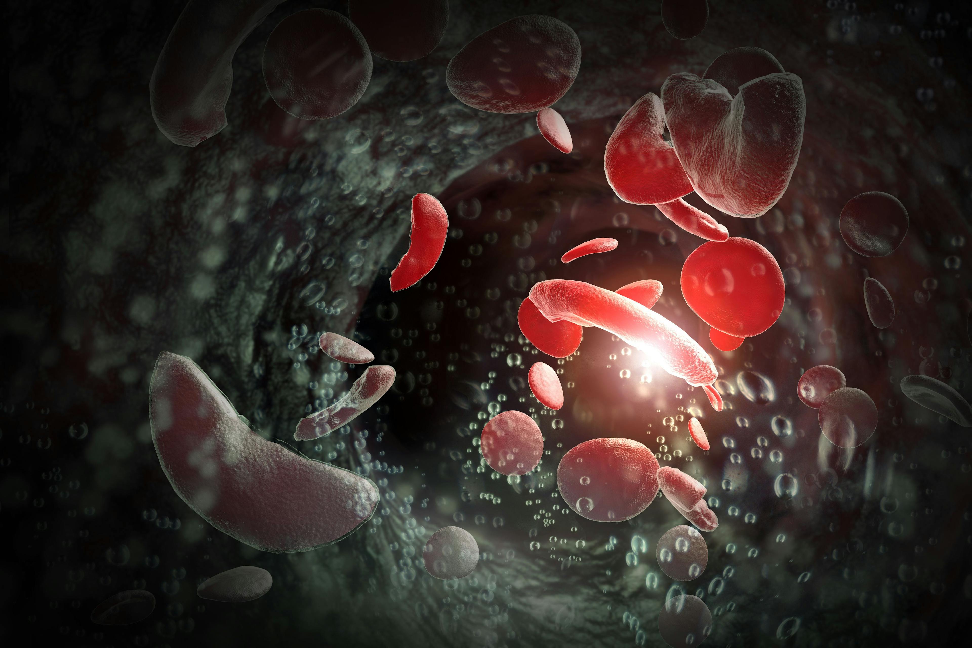 Sickle cell anemia illustration | Image credits: @Ezume Images stock.adobe.com